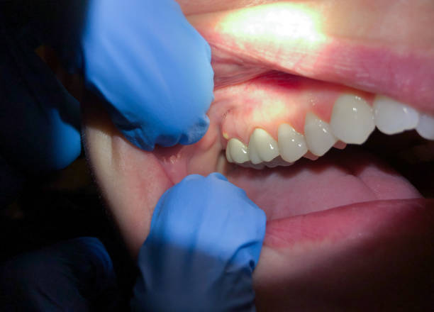 Best Emergency Gum Treatment in Augusta, AR